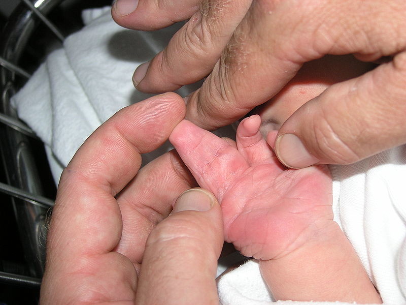 Een baby met vergroeide vingers
