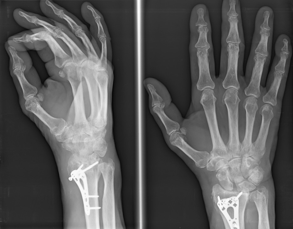 Röntgenfoto van een hand