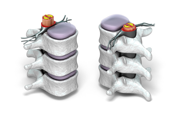 Ruggenwervels beschermen het ruggenmerg