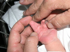 Een baby met vergroeide vingers